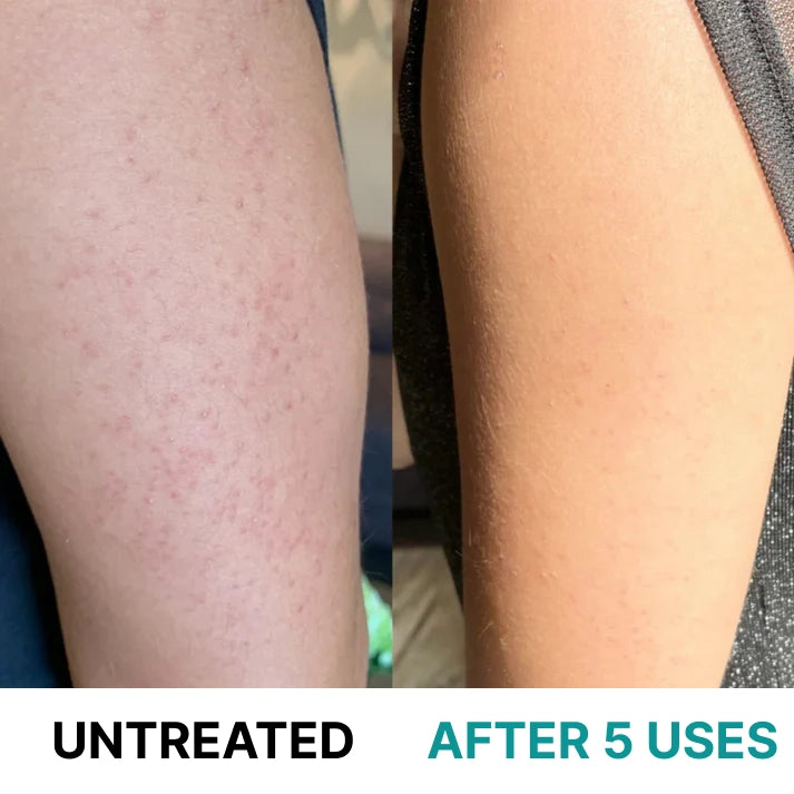 Multi-Acid Resurfacing Cream for Keratosis Pilaris