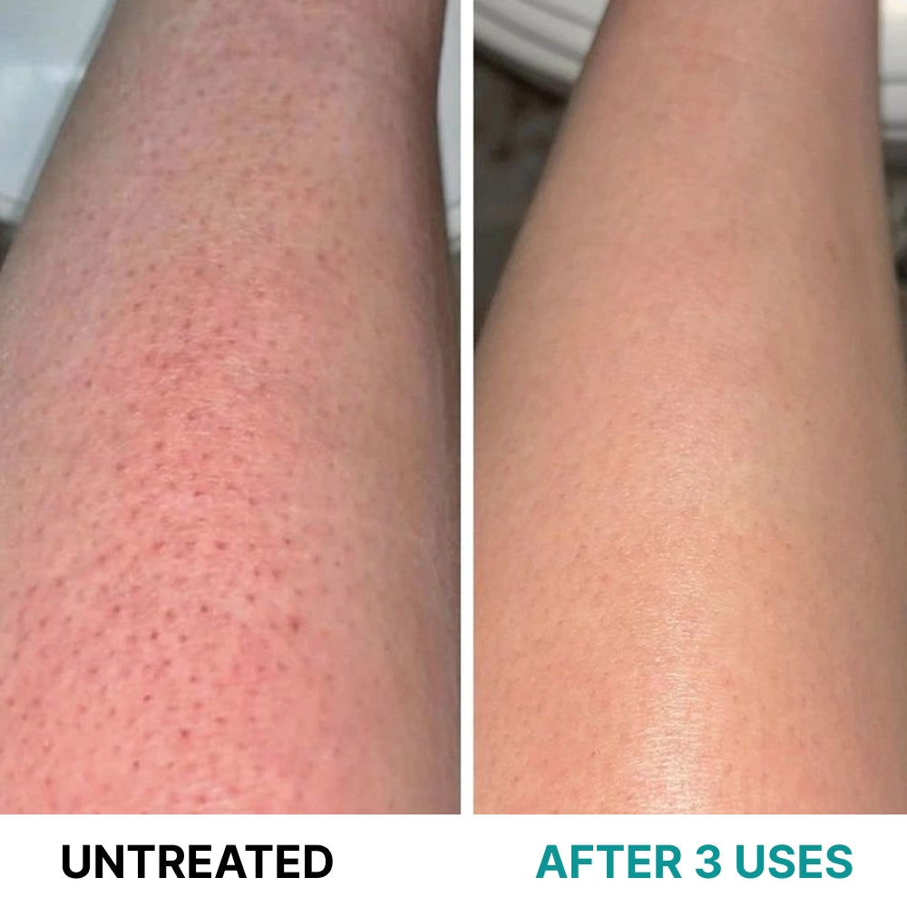 Multi-Acid Resurfacing Cream for Keratosis Pilaris
